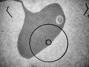F,1y. | bone marrow … dyserythropoetic anemia v.s.(digital photo from the screen) F,1y. | bone marrow … dyserythropoetic anemia v.s.(digital photo from the screen)